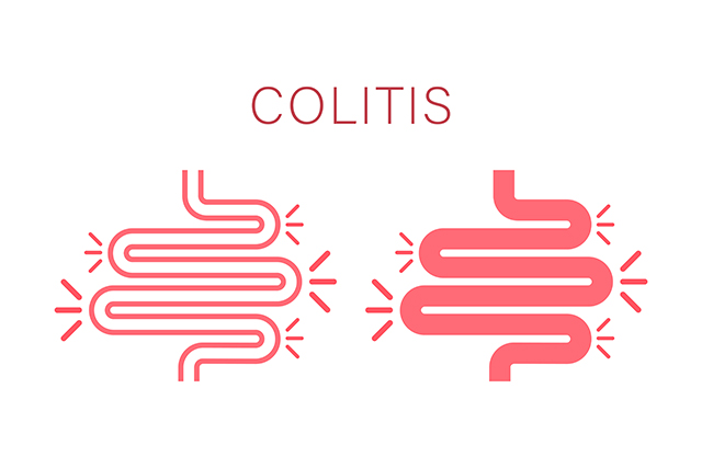 Microscopic Colitis