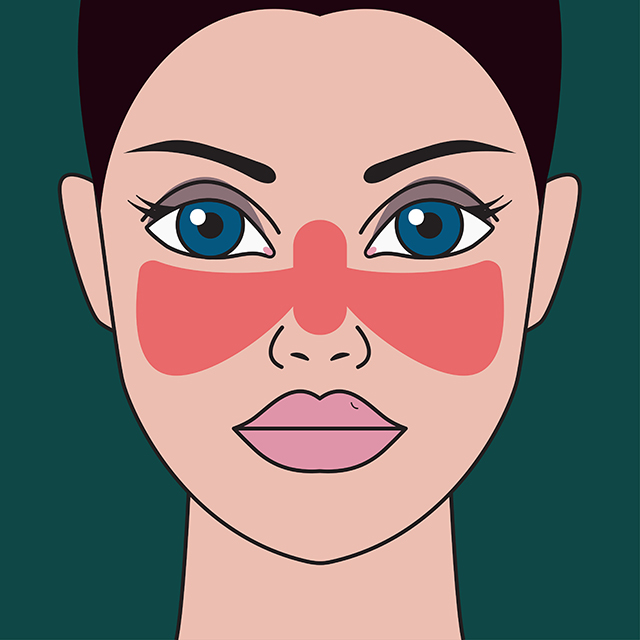 What to make of a positive ANA: recognizing lupus and related syndromes