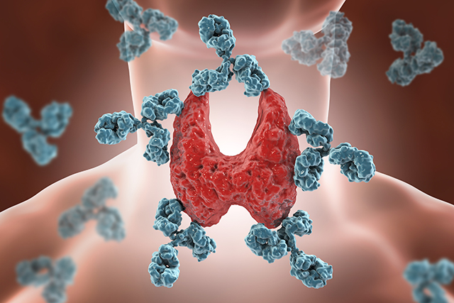 Naturopathic Integrative Diagnosis and Treatment of Hashimoto Thyroiditis